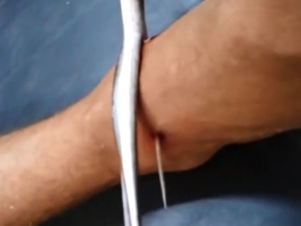 【閲覧注意】猛毒「アカエイ」のトゲが足を貫通した男