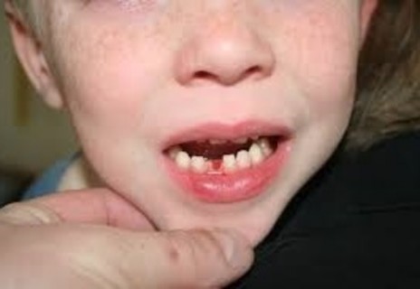 【閲覧注意】乳歯が抜ける前の子供の頭蓋骨ヤバすぎ