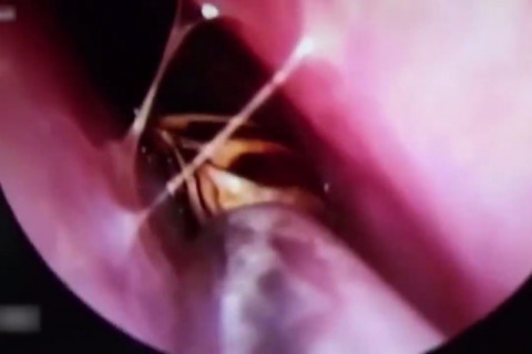 【閲覧注意】耳に入ったゴキブリ、頭蓋骨の中まで入り込む…（動画）
