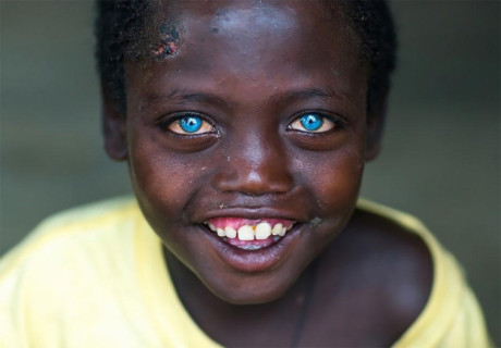 【画像】突然変異によって生まれた世界で最も美しい「目」を持つ少年、「アバーシュ」