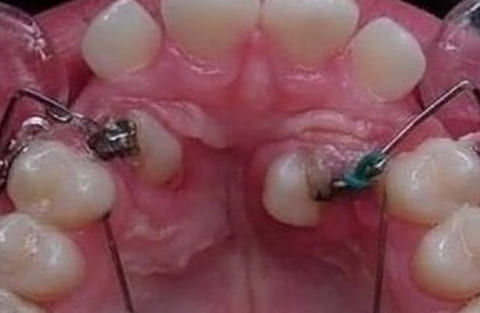 【驚愕】歯の矯正、「このレベルの歯」を元通りに矯正してしまう…（画像あり）