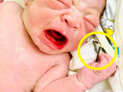 【画像】赤ちゃん、ママの子宮に装着された ”避妊具” を握り締め無事誕生…