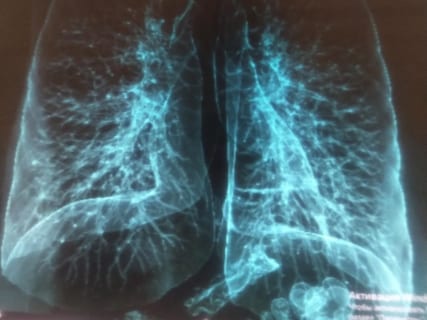 【衝撃】普通の人の「肺」とコロナ感染者の「肺」を比べた結果…（画像あり）