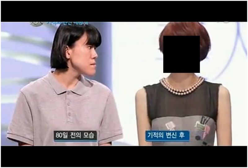 あごがしゃくれているおばさんが韓国のTV番組で顔面を整形。 ビフォーアフター