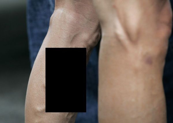 【閲覧注意】足の血管が拡張し蛇行し…ちょっとこれは…