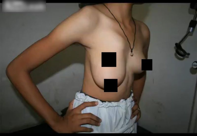 【閲覧注意】乳首が3つある女の子が1つ切り落とすらしい・・・