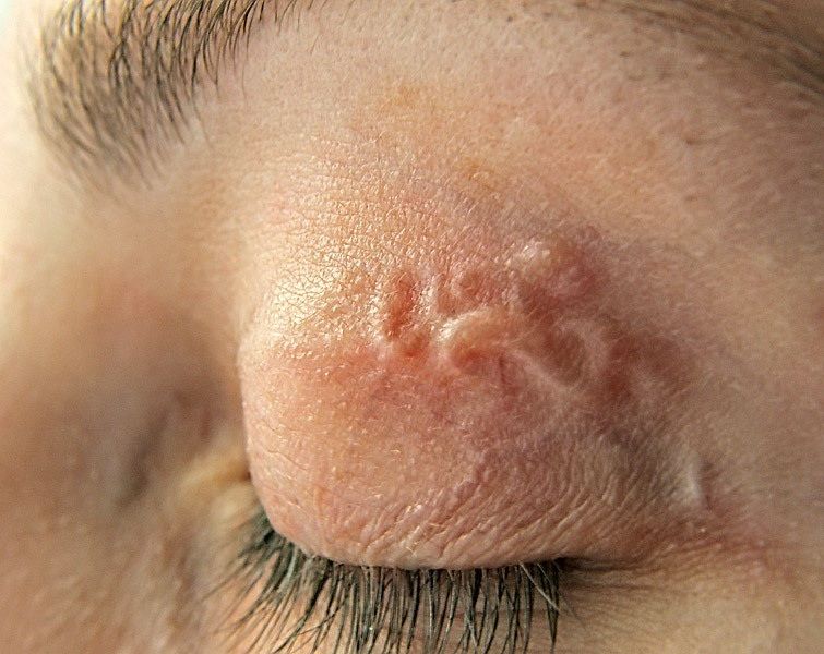 【閲覧注意】寄生虫に寄生されてる人の目ってどんな感じなの？