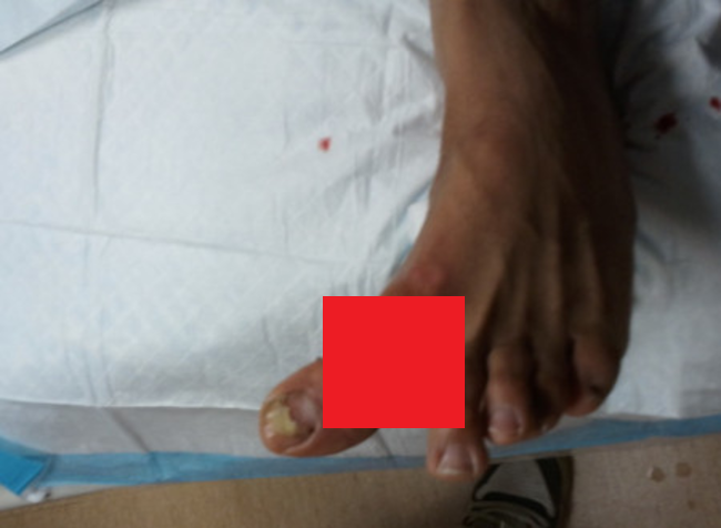 【閲覧注意】MMA選手が ”破壊された足” をTwitterに公開