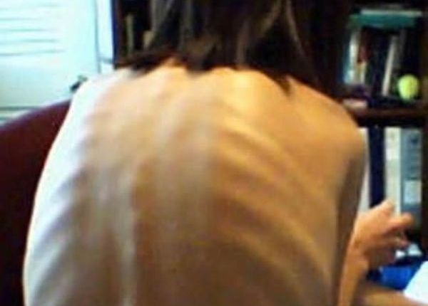 【閲覧注意】体重70kg ⇒ 30kgのダイエットに成功した女の子は…