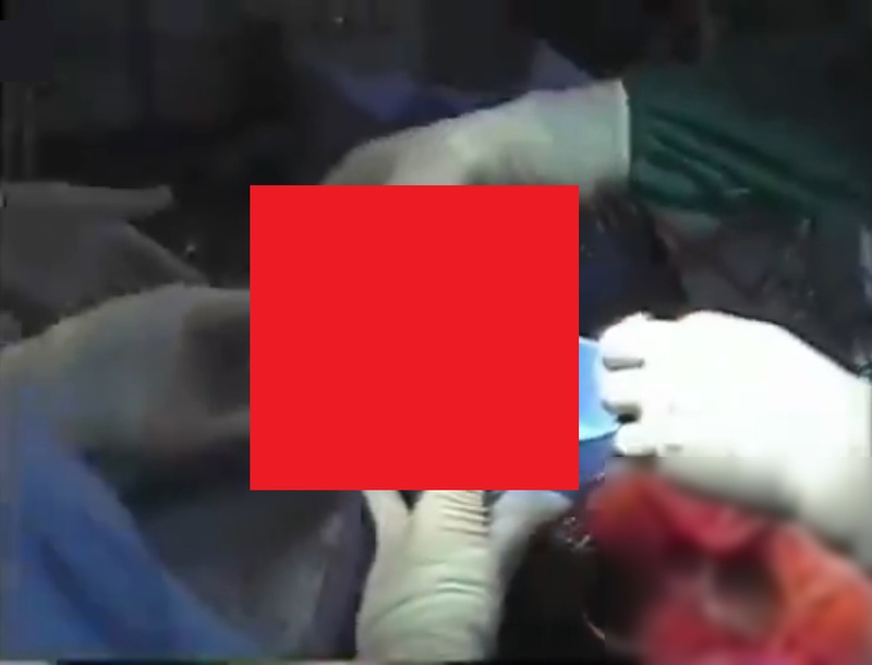 【閲覧注意】人間の脳から寄生虫が出てくる映像なんだけどこれちょっとおかしい