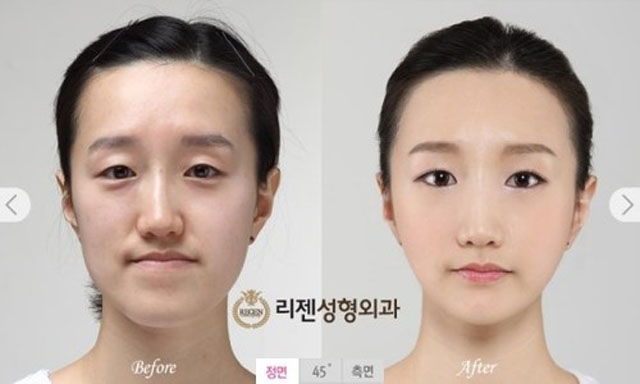 before_and_after_photos_of_korean_plastic_surgery_part_2_640_03