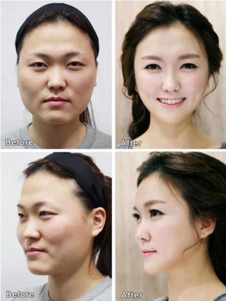 before_and_after_photos_of_korean_plastic_surgery_part_2_640_08