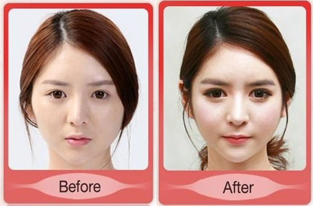 before_and_after_photos_of_korean_plastic_surgery_part_2_640_26