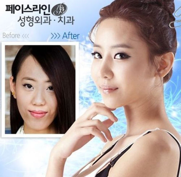 before_and_after_photos_of_korean_plastic_surgery_part_2_640_42