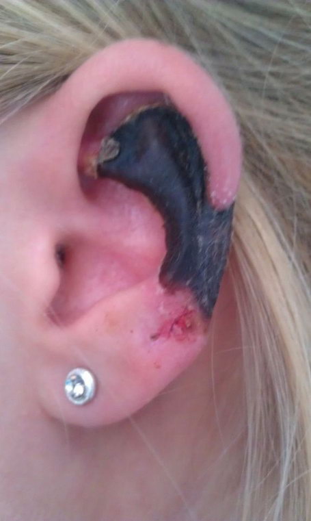 ear_spider_bite_01