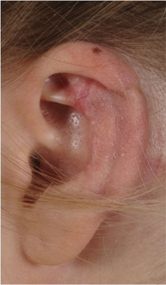 ear_spider_bite_03