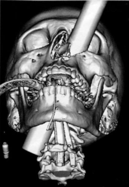 the_most_bizarre_items_that_have_gotten_stuck_in_peoples_bodies_640_05