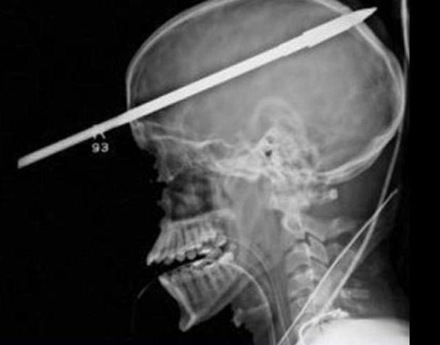 the_most_bizarre_items_that_have_gotten_stuck_in_peoples_bodies_640_07