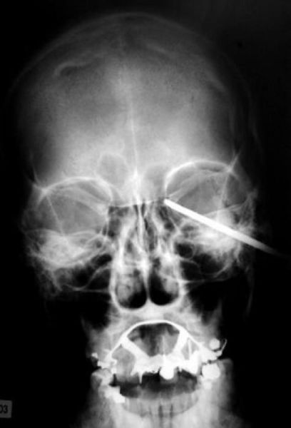 the_most_bizarre_items_that_have_gotten_stuck_in_peoples_bodies_640_11