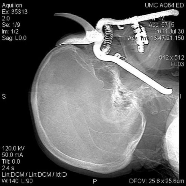 the_most_bizarre_items_that_have_gotten_stuck_in_peoples_bodies_640_21