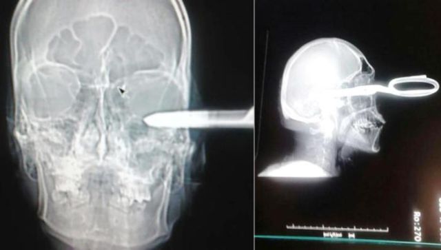 the_most_bizarre_items_that_have_gotten_stuck_in_peoples_bodies_640_24