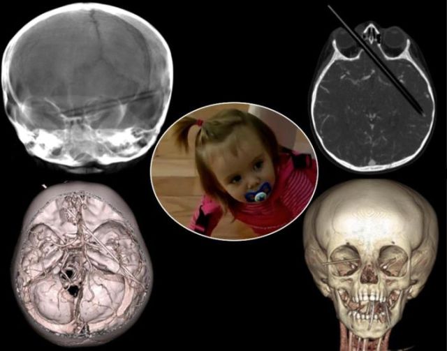 the_most_bizarre_items_that_have_gotten_stuck_in_peoples_bodies_640_25