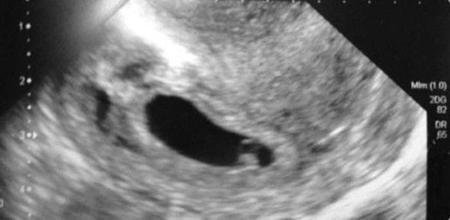 ultrasound_scare_02