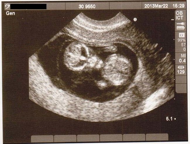 ultrasound_scare_05