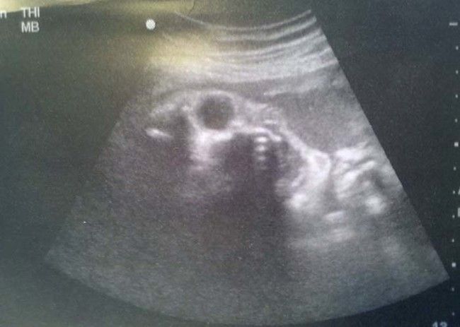 ultrasound_scare_09