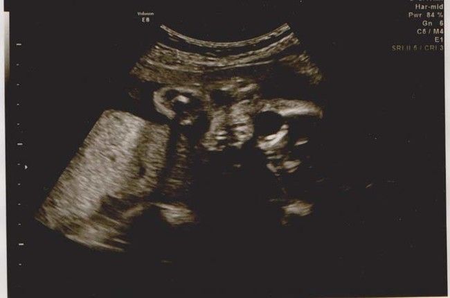 ultrasound_scare_12