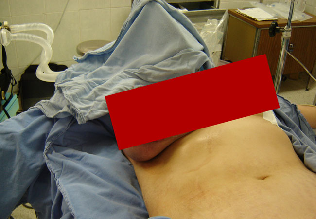 【閲覧注意】乳がんが進行したおっぱいヤバすぎ・・・（8枚）