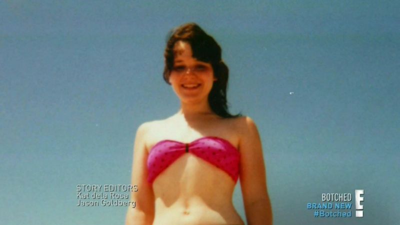 udalenie-grudnyh-implantatov_01