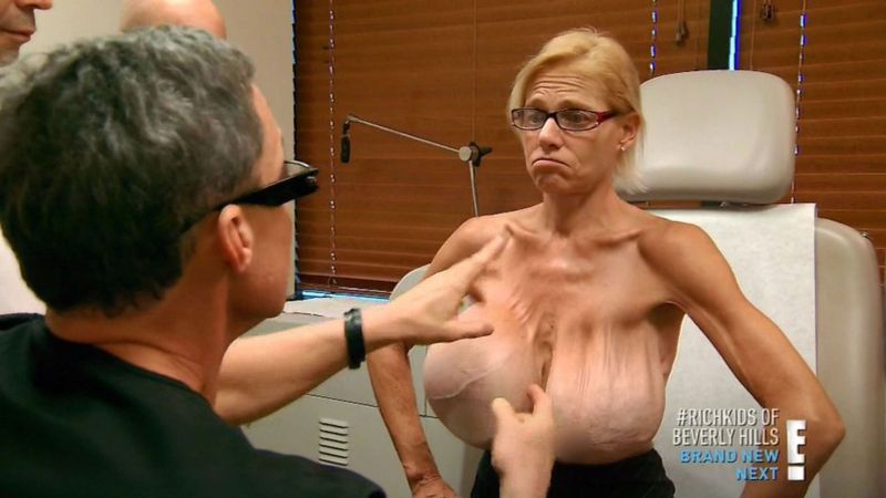 udalenie-grudnyh-implantatov_05