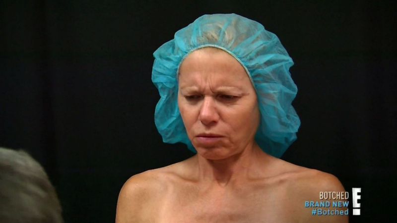 udalenie-grudnyh-implantatov_07