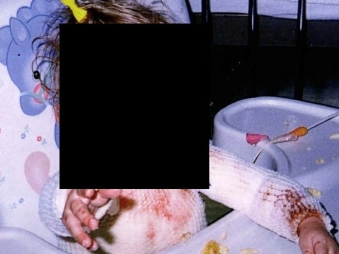 【閲覧注意】「スティーブンス・ジョンソン症候群」って初めて聞いたけど患者の画像がヤバすぎる