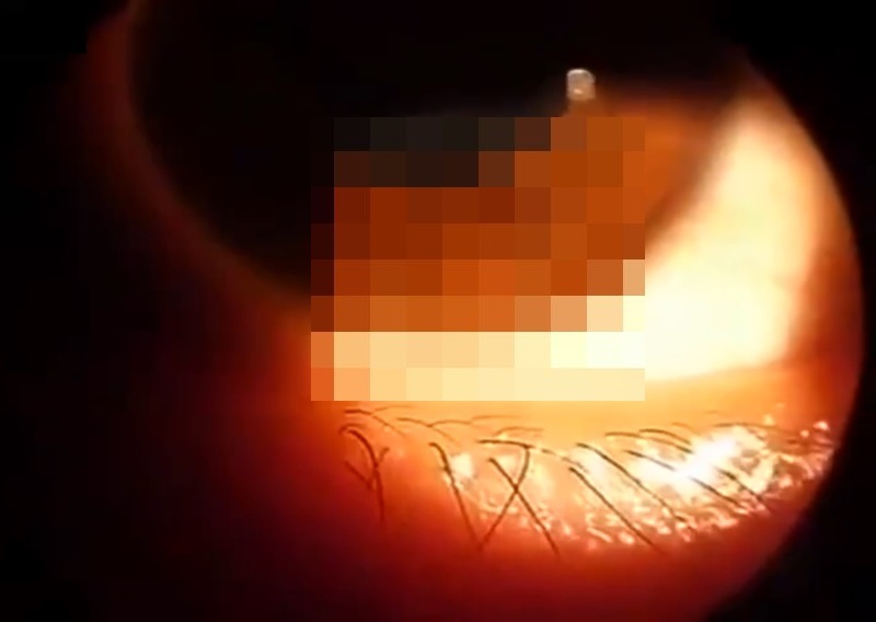 【閲覧注意】女性の目をアップ ⇒ 虫がうごめいていた… (動画)