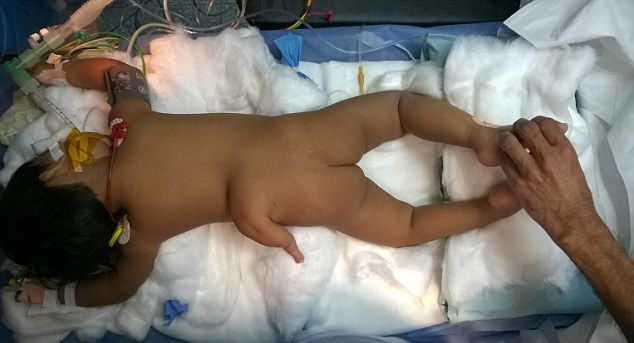 udalenie-tretej-nogi_01