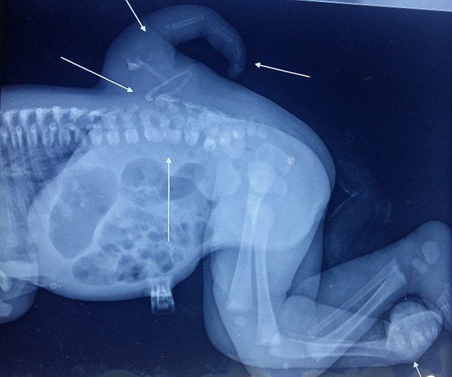 udalenie-tretej-nogi_02