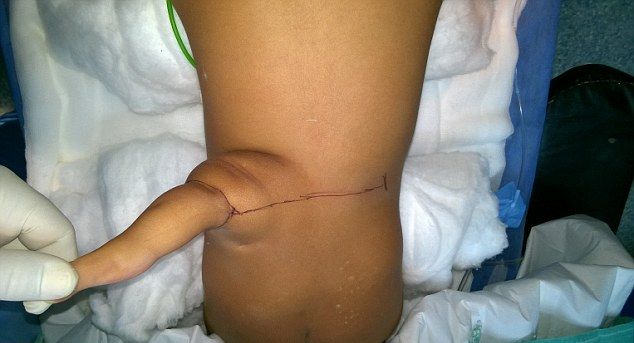 udalenie-tretej-nogi_03