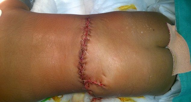 udalenie-tretej-nogi_04