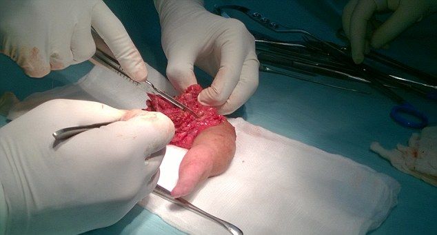 udalenie-tretej-nogi_05