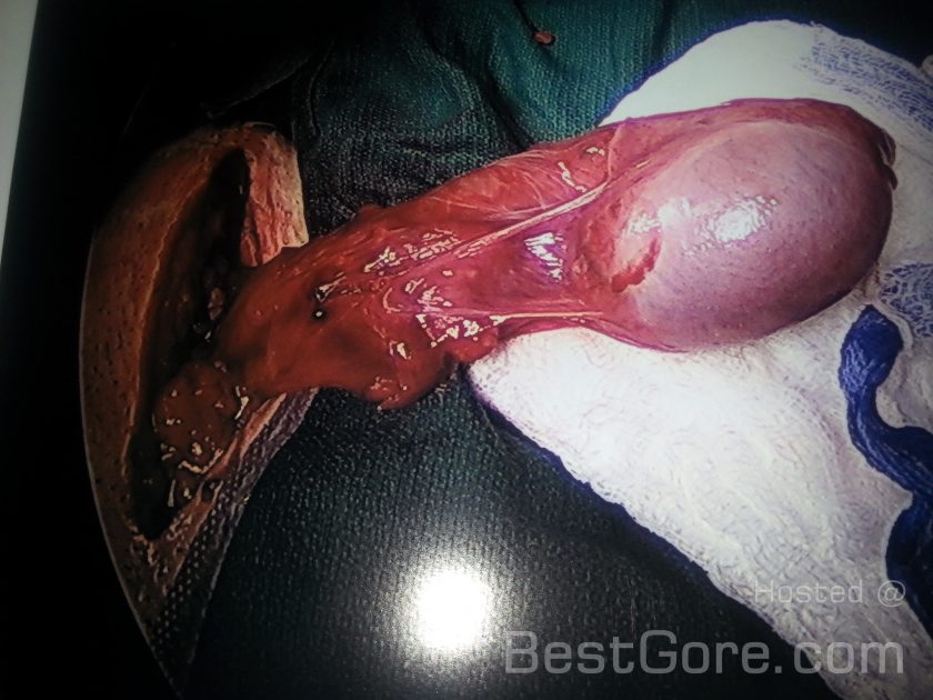 testicle-extraction-out-body-due-to-complication-during-surgery-840x630