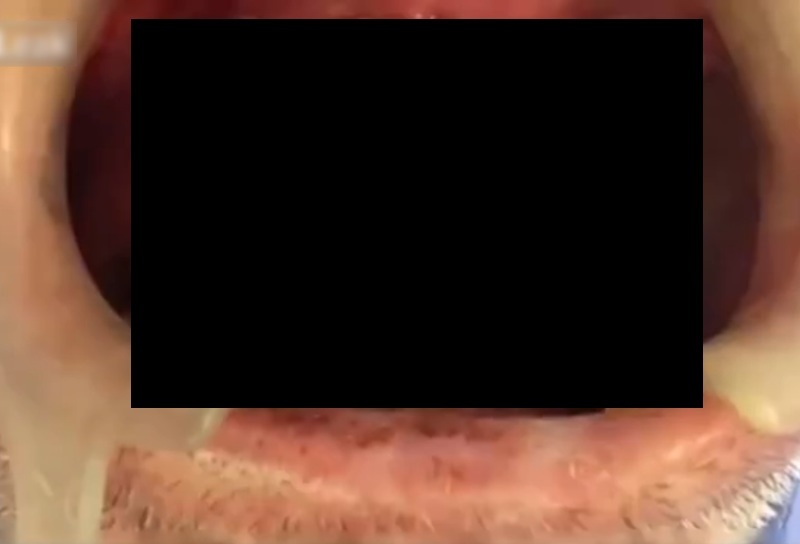 【閲覧注意】歯医者に凄い患者が来た。虫歯じゃなくて虫が住んでる・・・（動画）