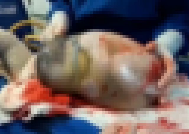 【閲覧注意】これが「8万人に1人」しか生まれない赤ちゃんの姿です