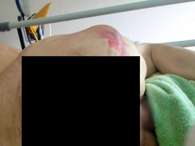 【閲覧注意】寝たきりのおじいちゃんの背中見たら生きているのが不思議なレベルだった