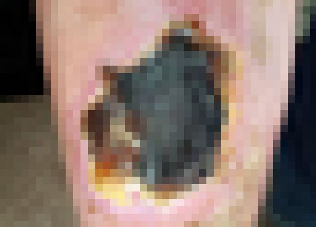 【閲覧注意】夜見た事ない虫に刺されたんだけど、その後の足がヤバい（画像）
