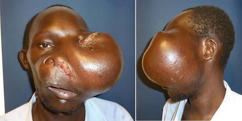 muzhchina-s-opuholju-na-lice_01