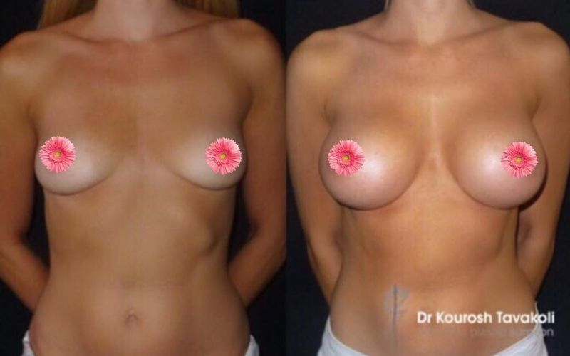 5000人の女子の ”おっぱい” を改造した医師。Instagramで画像を公開・・・（24枚）