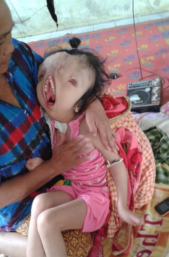 LiveLeak-dot-com-32d_1492690789-thai-child-suffers-monstrous-facial-defo_1492692155