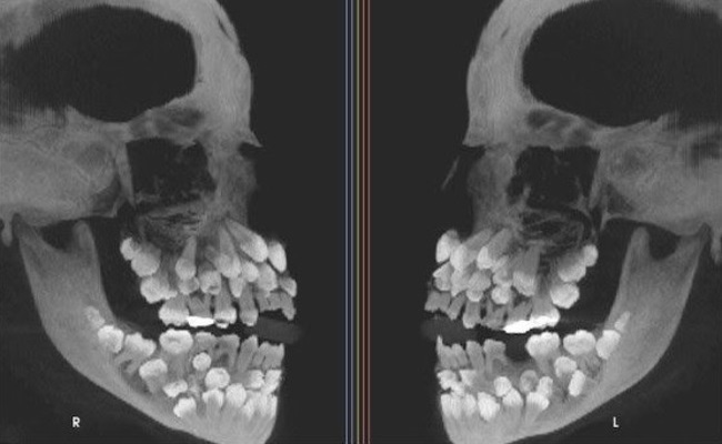 【閲覧注意】「過剰歯」とかいう病気の画像マジで怖すぎだろ